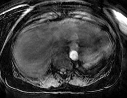 Focal hepatic observations: Evaluation for focal observations is limited by moderate to severe motion artifact on