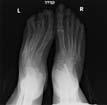 The Ilizarov technique of distraction osteogenesis 5 has been used to correct residual clubfeet with encouraging results.