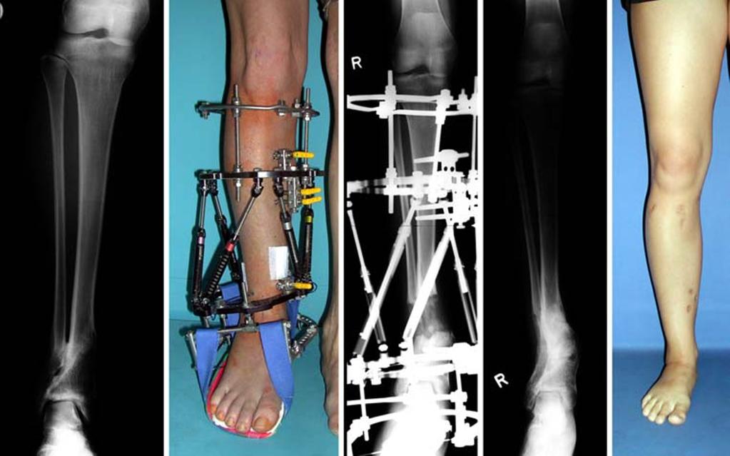 56 J Child Orthop (2007) 1:55 61 mity [5], and has become widely accepted for the correction of various deformities of the upper and lower limb.