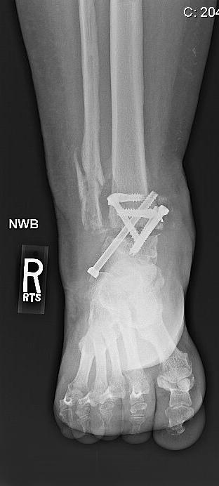 PR O D U CTS CONDITION Nonunion of an attempted ankle arthrodesis with limb length discrepancy Patient History (Continued) PRODUCT 10.