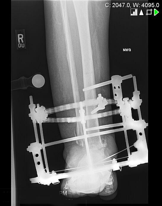 The patient underwent removal of the external fixator 5 months post fusion surgery. Her subtalar joint went on to collapse into valgus over the ensuing 6 months.