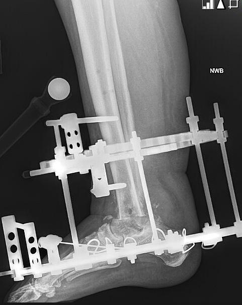 arthrodesis. She had sustained an open ankle fracture dislocation treated with external fixation and staged internal fixation.