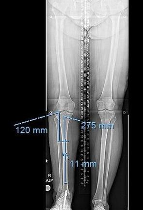 Preoperative Planning The goal was for a 41 mm tibial lengthening. The planning of the lengthening nail required measuring the radiograph (Fig. 5a).