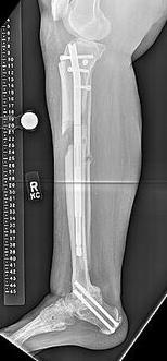 The tibia was lengthened in 0.25 mm increments, 4 times per day for 4 days and then slowed to three times a day for 49 days.