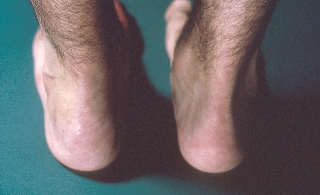 Clinical features of axial SpA 5. Enthesitis Enthesitis is inflammation with or without pain of the sites of insertion of tendon, ligament, fascia or joint capsule to bone.