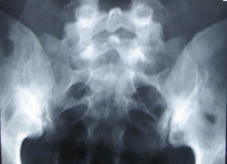 Defining radiographic sacroiliitis Radiographic sacroiliitis is defined as bilateral grade 2 4 or unilateral grade 3 4, as per the modified New York Criteria (mnyc).