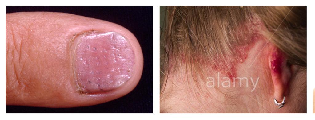 Typical manifestations include moderate-to-severe nail changes and scaly patches and plaques Nail pitting image courtesy of