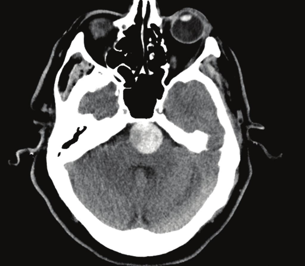 2 Figure 1: CT head without contrast: 25 mm basilar artery aneurysm with partial thrombosis and no evidence of rupture.
