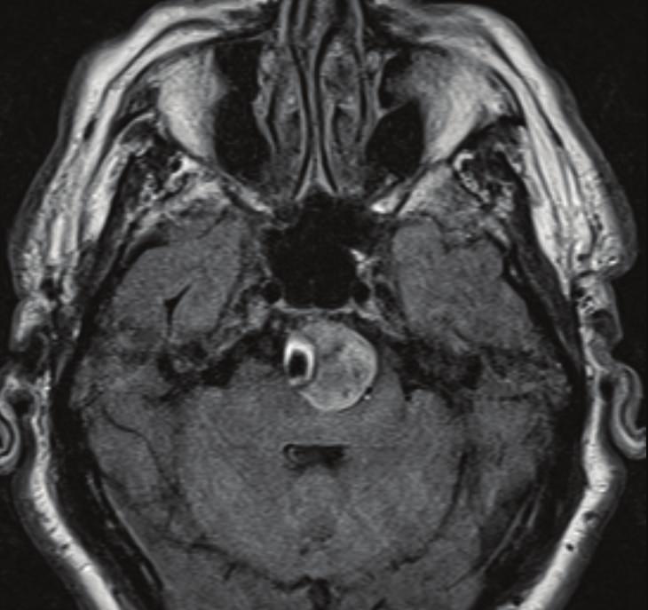 Our patient presented with ischemic symptoms with a very large Case Reports in Emergency Medicine Figure 3: Head CTA: There is a very large aneurysm of the basilar artery measuring 25 mm in diameter,