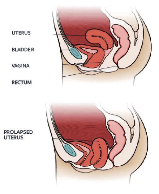 Pelvic Organ Prolapse (POP) Pelvic Organ Prolapse (POP) is the descent of one or more pelvic organs into the vagina.
