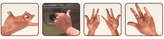 Signs and Symptoms Unit 2: Dupuytren's Contracture (Fig.
