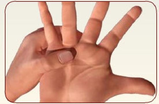 Conservative Treatment Options You may not need treatment for Dupuytren s contracture if the condition is not affecting your ability to perform daily activities.