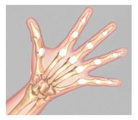 The volar plate is the strongest ligament in the hand and prevents hyperextension of the PIP joint. (Refer fig. 12) (Fig.