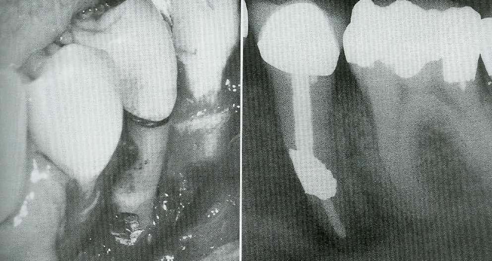 reflection. C, Post is reduced to within root and cavity filled with amalgam (D). 2- Resorptive perforations.