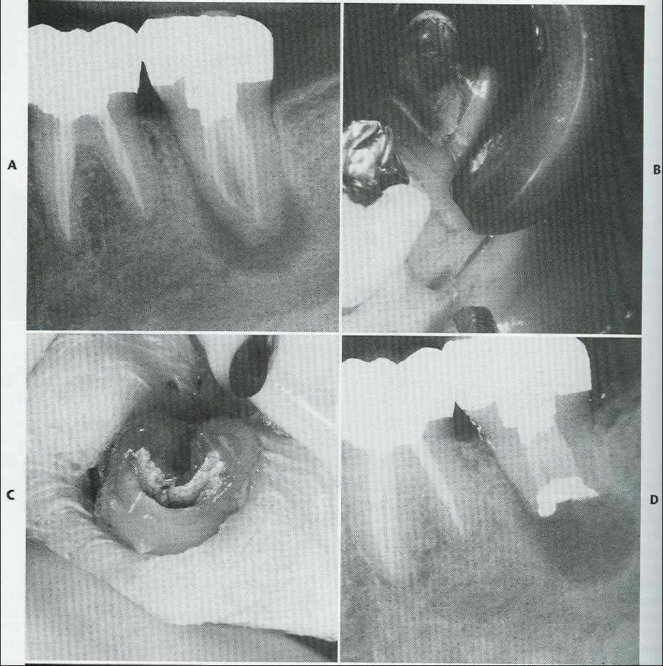 pressure by forcibly blowing the nose until the surgical wound has healed (in 1 to 2 weeks). B- The external oblique ridge over the mandibular second and third molars.