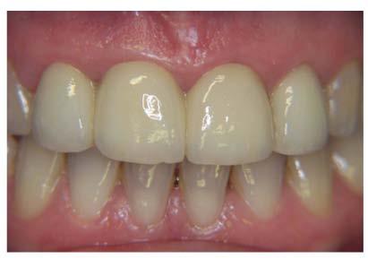 procedures for correction of gummy smile, asymmetry and clinical crown height/ferrule Practical experience of crown lengthening procedures and stages A