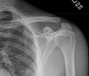 The Root Cause & Treatment: Acromioclavicular Joint Sprain Non Surgical Care:
