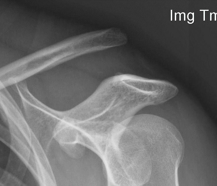 and physical therapy Surgical Care: Grade III-VI Coracoclavicular interval