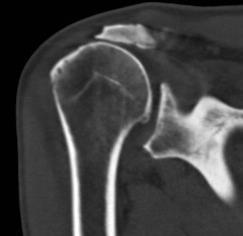 AC joint arthritis Often found in conjunction with RC
