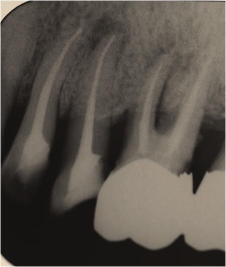 on the culture plate (Figure 8), including black-pigmented bacteria (BPB), which indicated a mixed infection of the root canal. Irrigation with sodium hypochlorite and Calcipex dressing was continued.