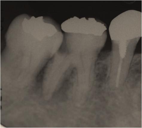 Ca(OH) 2 4 (19) Scattered colonies Ca(OH) 2 5 (26) No colonies Ca(OH) 2 6 (30) (Not done) (Root canal filling) Figure 6: Case 1: Radiography 2 months after the initial visit showing that the