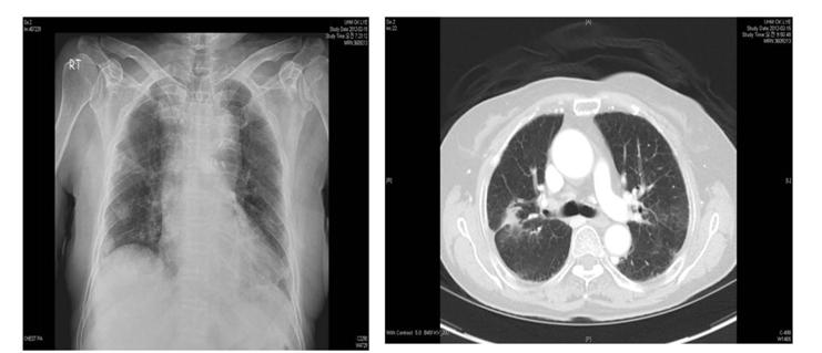 Chest CT after therapy (09-May-2012) Advanced adenocarcinoma of lung 48 year old male