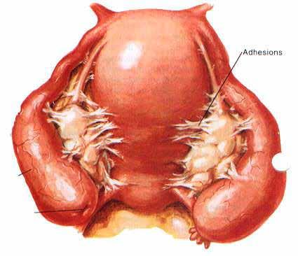 Pelvic Inflammatory Disease This is the name for inflammation of the tubes with pus formation and scarring of the tubes.