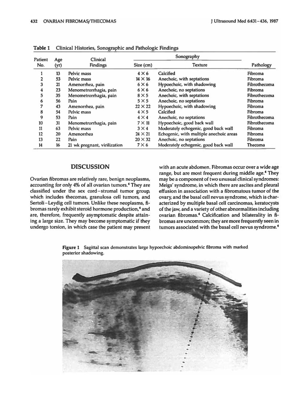 432 OVARIAN FIBROMAS/THECOMAS J Ultrasound M~ 6:431-436,1987 Table 1 Clinical Histories, Sonographic and Pathologic Findings Patient Age Clinical No.