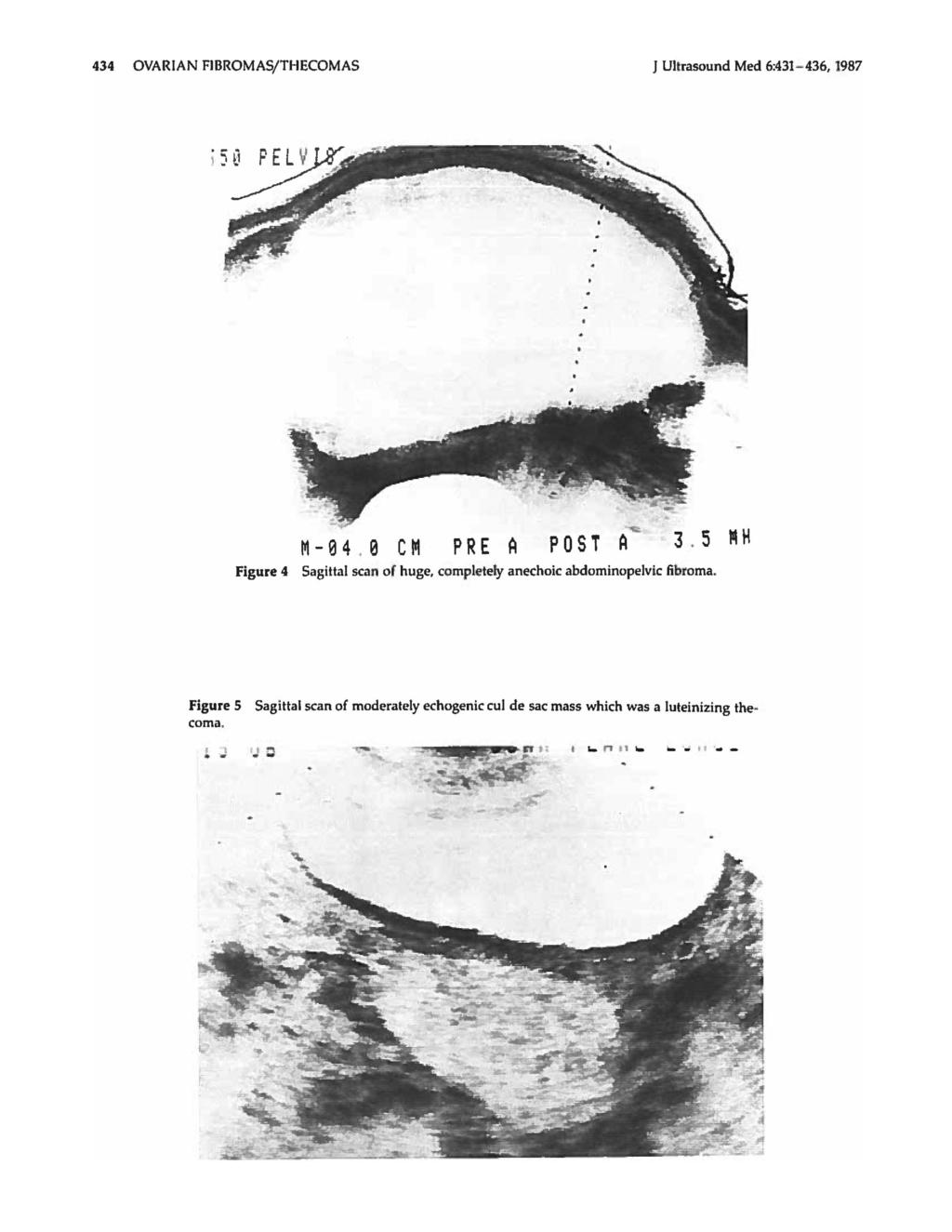434 OVARIAN FIBROMAS/THECOMAS J UUrasound Med 6:431-436, 1987 M-04. 0 em PRE A POST A 3. 5 Figure 4 Sagittal scan of huge.