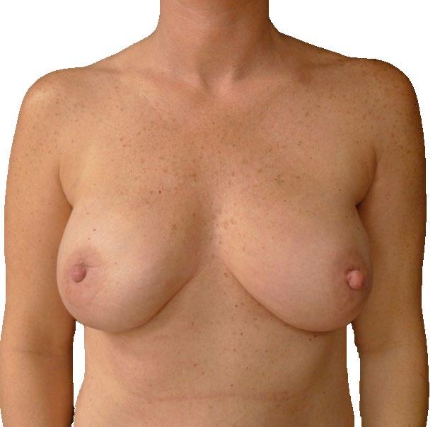 Nipple sparing mastectomy: Advantages Superior cosmetic outcome Increases chance of single stage implant reconstruction 6 wks