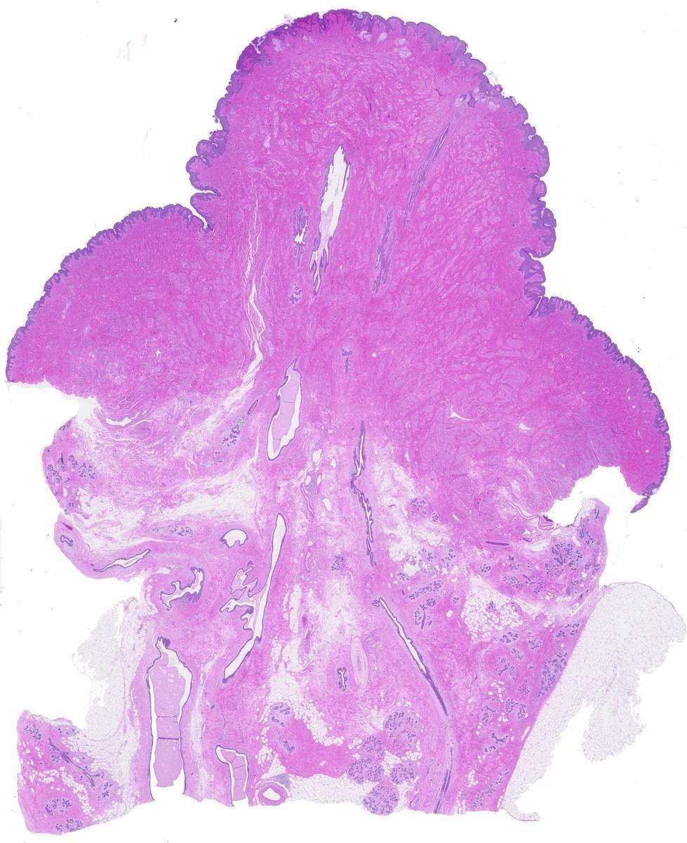 Nipple margin anatomy Subareolar/ nipple duct margin Ductal tissue within nipple