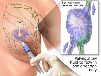 Sentinel node mapping Radioactive and/or blue particles injected near tumor or areola