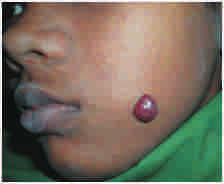 249 Case Report A 10 year old female visited the dental clinic with a chief complaint of a red swelling on the left cheek since 6 months. Her medical history was non-contributory.