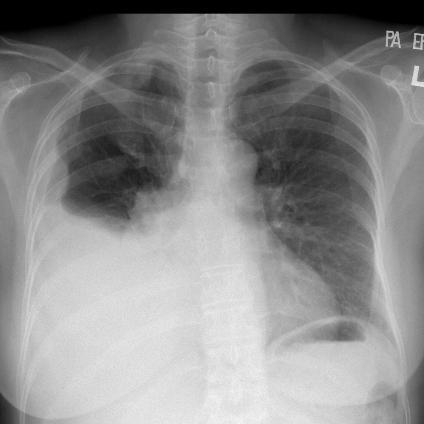 Radiological diagnosis Circumferential lobulated pleural thickening