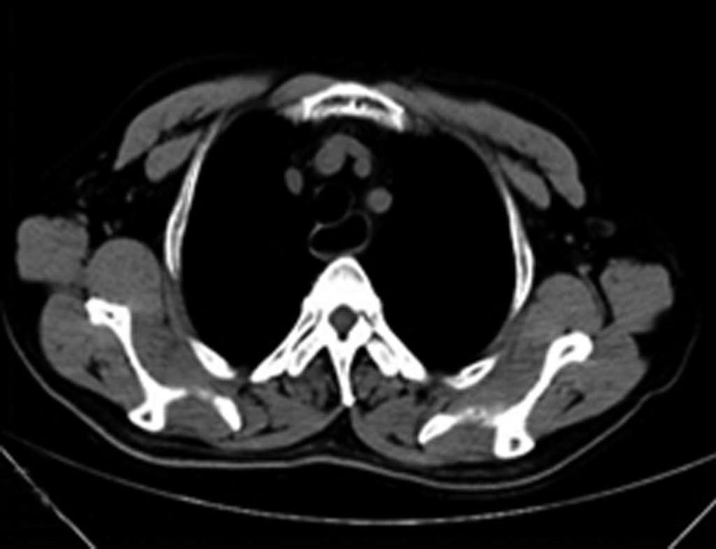 A B C D Figure 1 Chest computed tomography examination showed that the esophageal cavity was