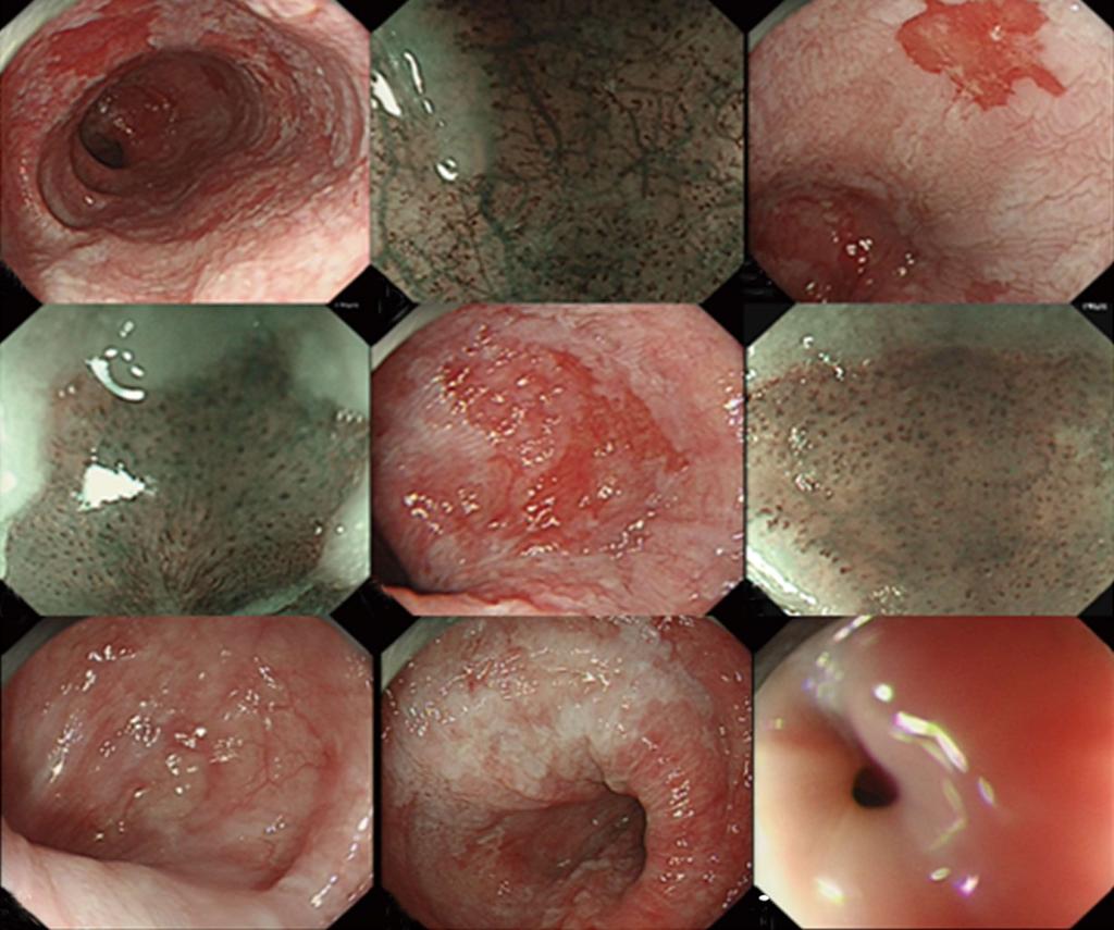 classification; C, D: Another lesion at 32 cm, IPCLs were type Ⅴ1; E, F: The third lesion in 34