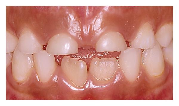 Erosion in Primary Dentition of 6-year-old girl Shortening of crown