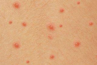 Chickenpox Symptoms 水痘病徵 An itchy rash of blisters 痕癢的紅疹 豆狀小水疱 Fever 發燒