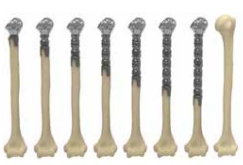 with significant humeral bone loss and following removal of bone tumors in humerus.