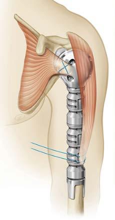 with a range of heights (as seen to the right) depending on how much of the humeral shaft is