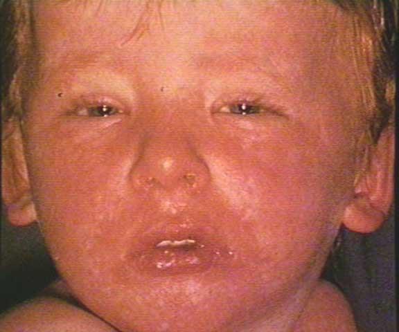 Virtually everyone got measles before a vaccine was developed.