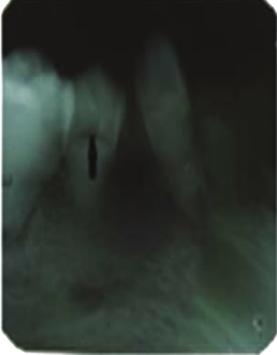 Case Reports in Dentistry 3 (a) (b) (c) (d) Figure 3: Intraoral periapical radiographs showing horizontal/crescent shaped pulpal remnants in pulp chambers (black arrows).