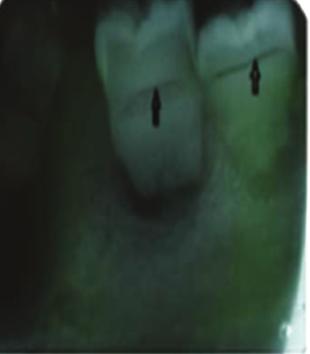 Our case clearly demonstrates this feature in addition to other radiographic findings like short roots, pulpal obliterations, and multiple periapical radiolucencies.