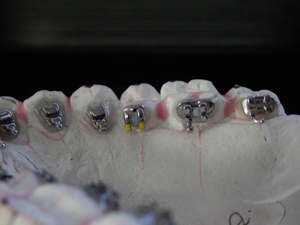 Here I did a mix of ORG Mini anterior brackets with 018 molars from the same company, but another bracket system.