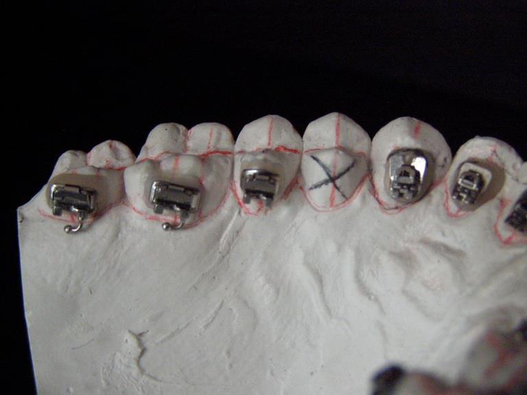 on all teeth if mini screws are used, you