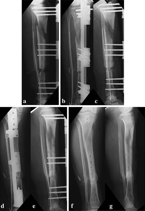 a Bone transport (descending technique) in previous proximal tibial closed fracture and distal exposed fracture with loss of bone.