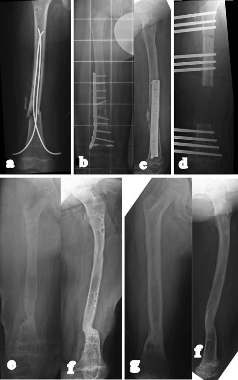 Strat Traum Limb Recon (2010) 5:17 22 19 Fig. 4 C.A., man, aged 28. a, b Osteomyelitis after exposed fracture with bone gap, treated with external fixator and later osteosynthesis.