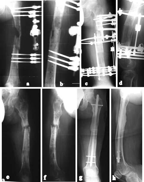 a c Osteomyelitis secondary upon previous operations. d Check-up after resection, application of monolateral fixator and osteotomy for transport.