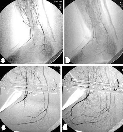 20 Strat Traum Limb Recon (2010) 5:17 22 Fig. 5 F.L., man, aged 32. a, b Arteriography in an exposed tibial fracture with loss of bone.