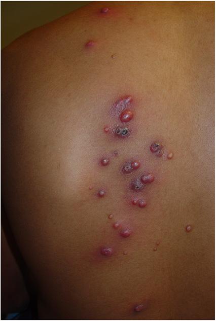 CASE REPORT Molluscum contagiosum is a common skin infection caused by the molluscipox virus that classically manifests as multiple, regionally clustered, 1- to 3- mm pearly dome-shaped papules with
